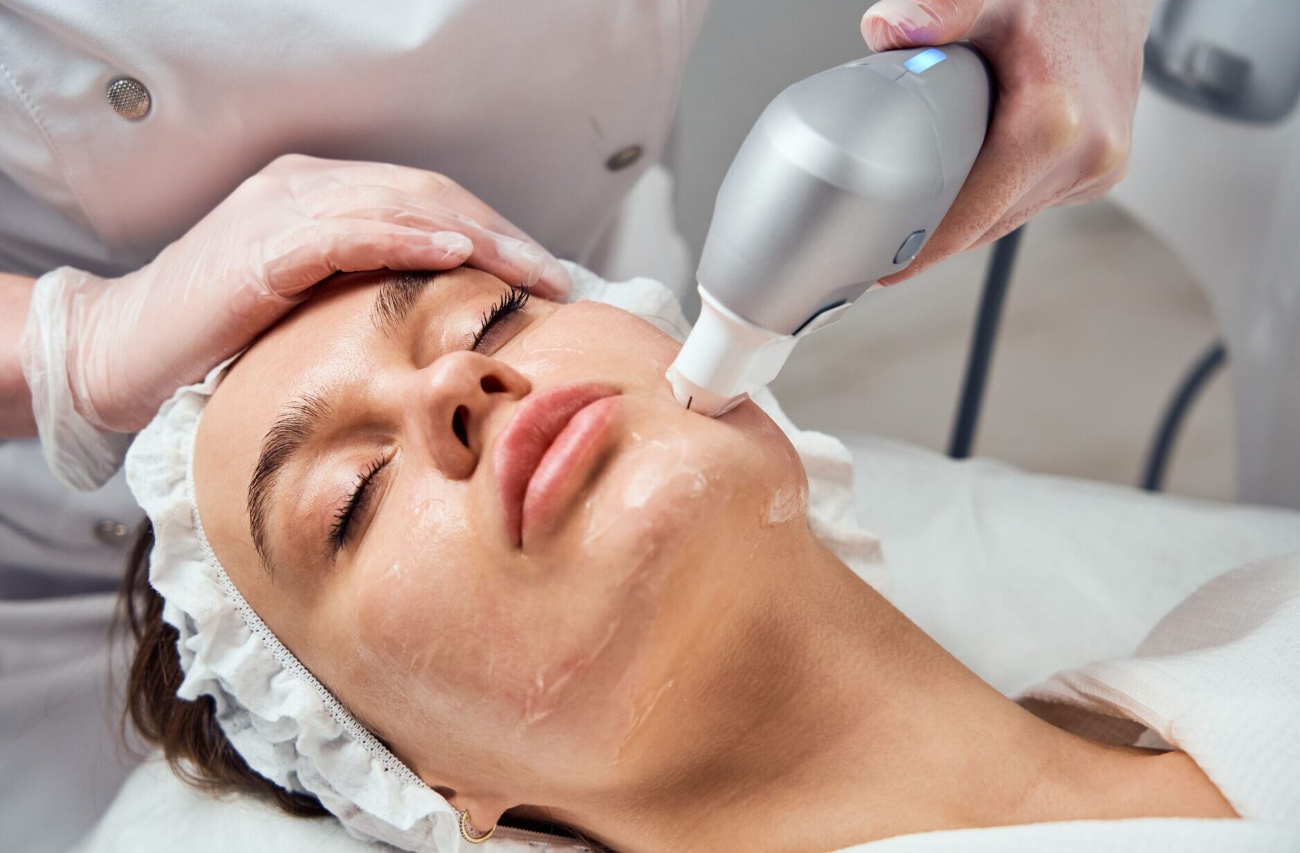 Aplicação de ultrassom microfocado no rosto de uma paciente