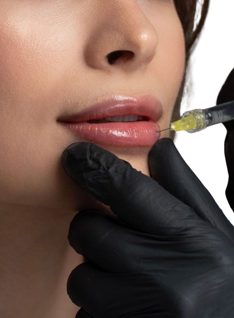 Aplicação de preenchimento labial